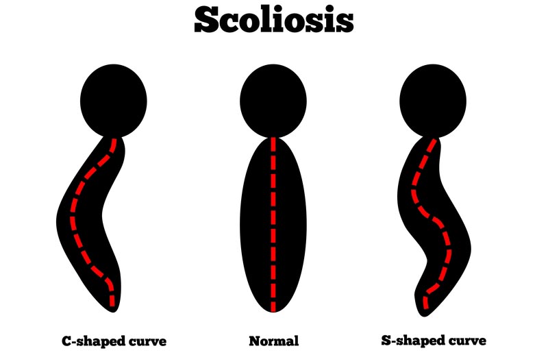 Coeur D'Alene, ID scoliosis treatment